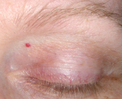 red-spot-in-eye